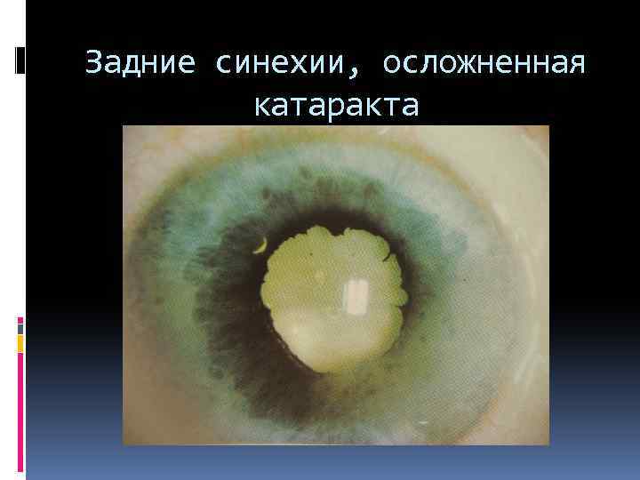 Задние синехии, осложненная катаракта 