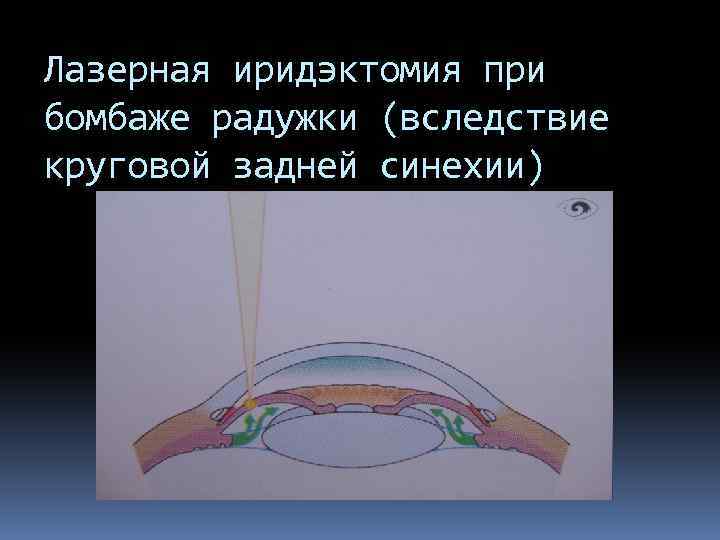 Лазерная иридэктомия при бомбаже радужки (вследствие круговой задней синехии) 