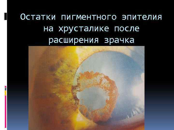 Остатки пигментного эпителия на хрусталике после расширения зрачка 