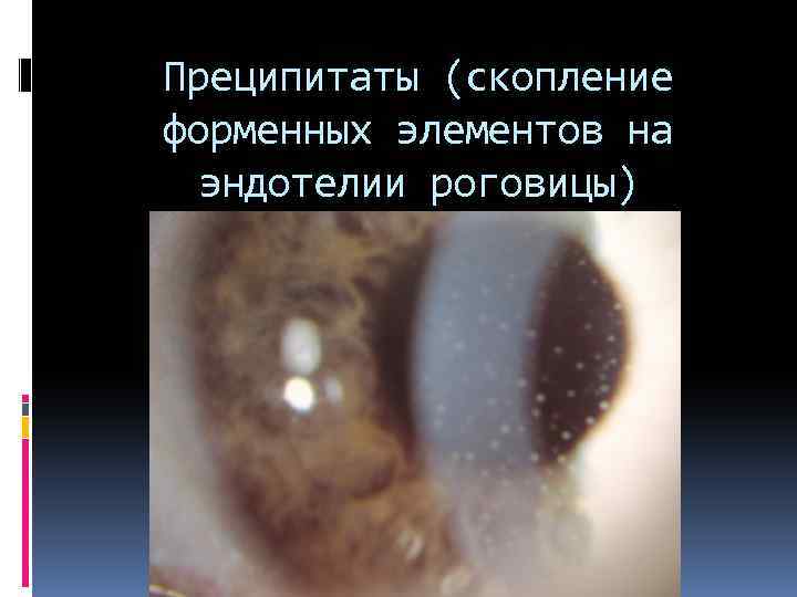 Преципитаты (скопление форменных элементов на эндотелии роговицы) 