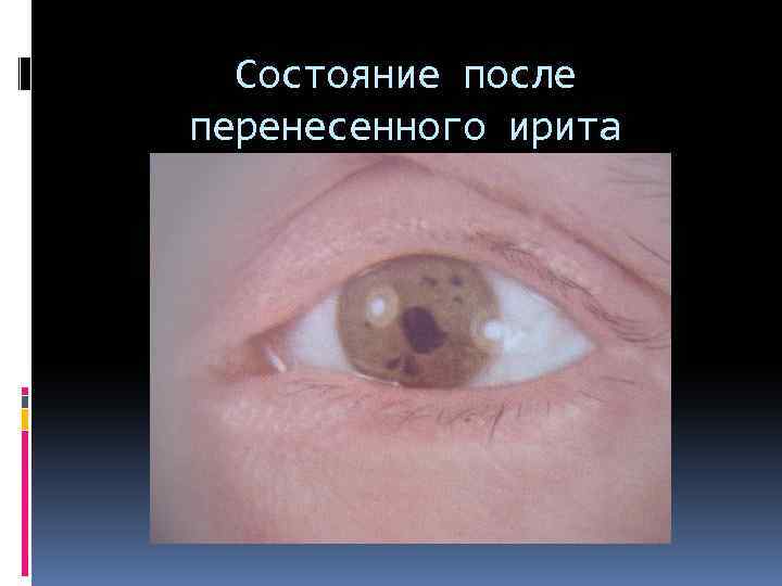 Состояние после перенесенного ирита 
