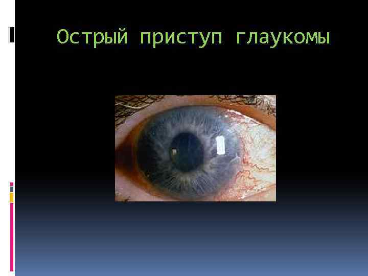 Острый приступ глаукомы 