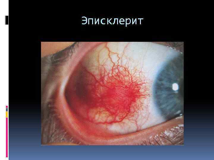 Эписклерит 
