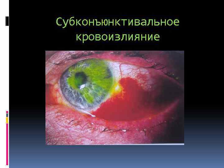 Субконъюнктивальное кровоизлияние 