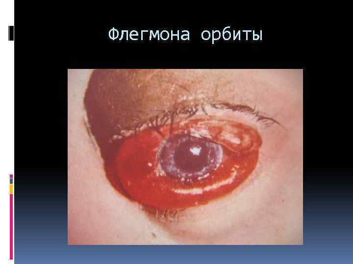Флегмона орбиты 
