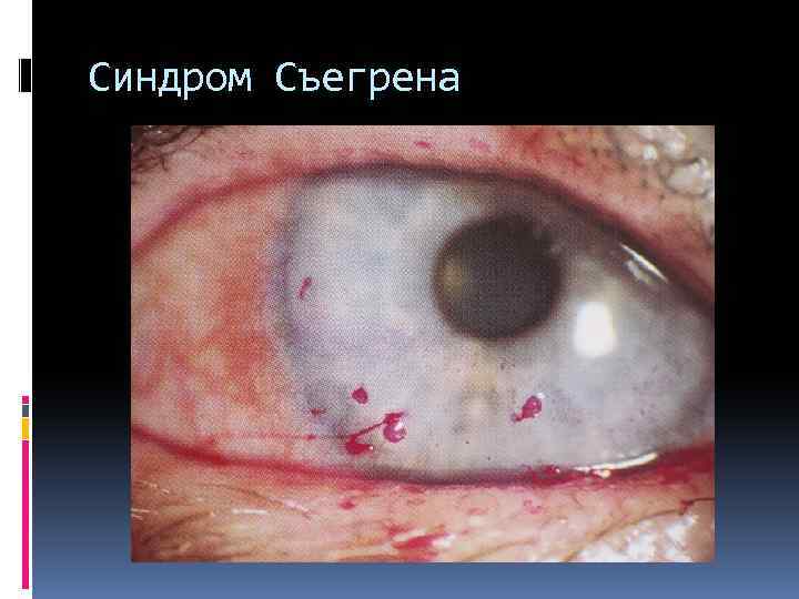 Синдром Съегрена 