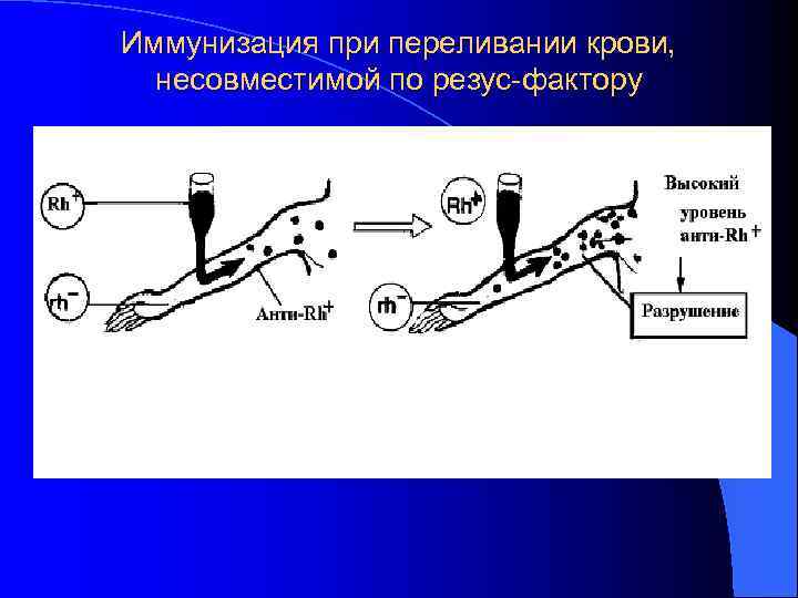 Иммунизация при переливании крови,  несовместимой по резус-фактору 