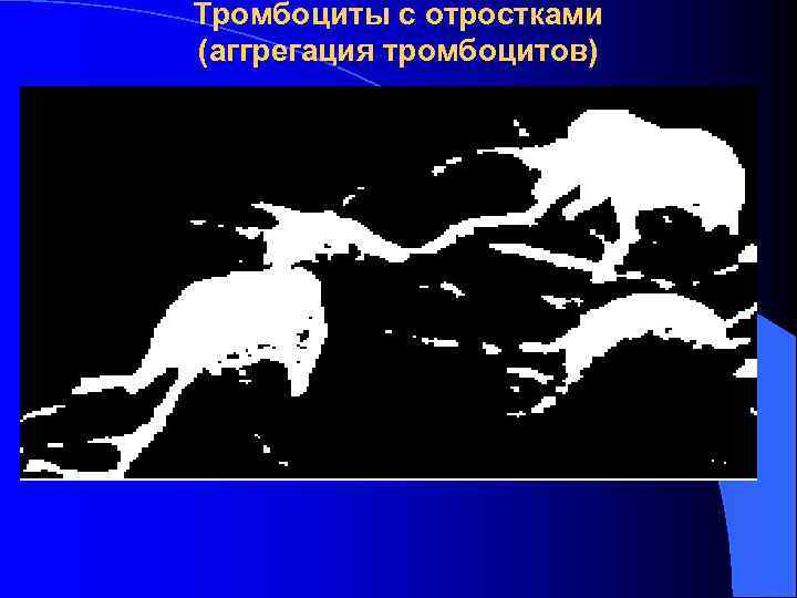 Тромбоциты с отростками (аггрегация тромбоцитов)    l 