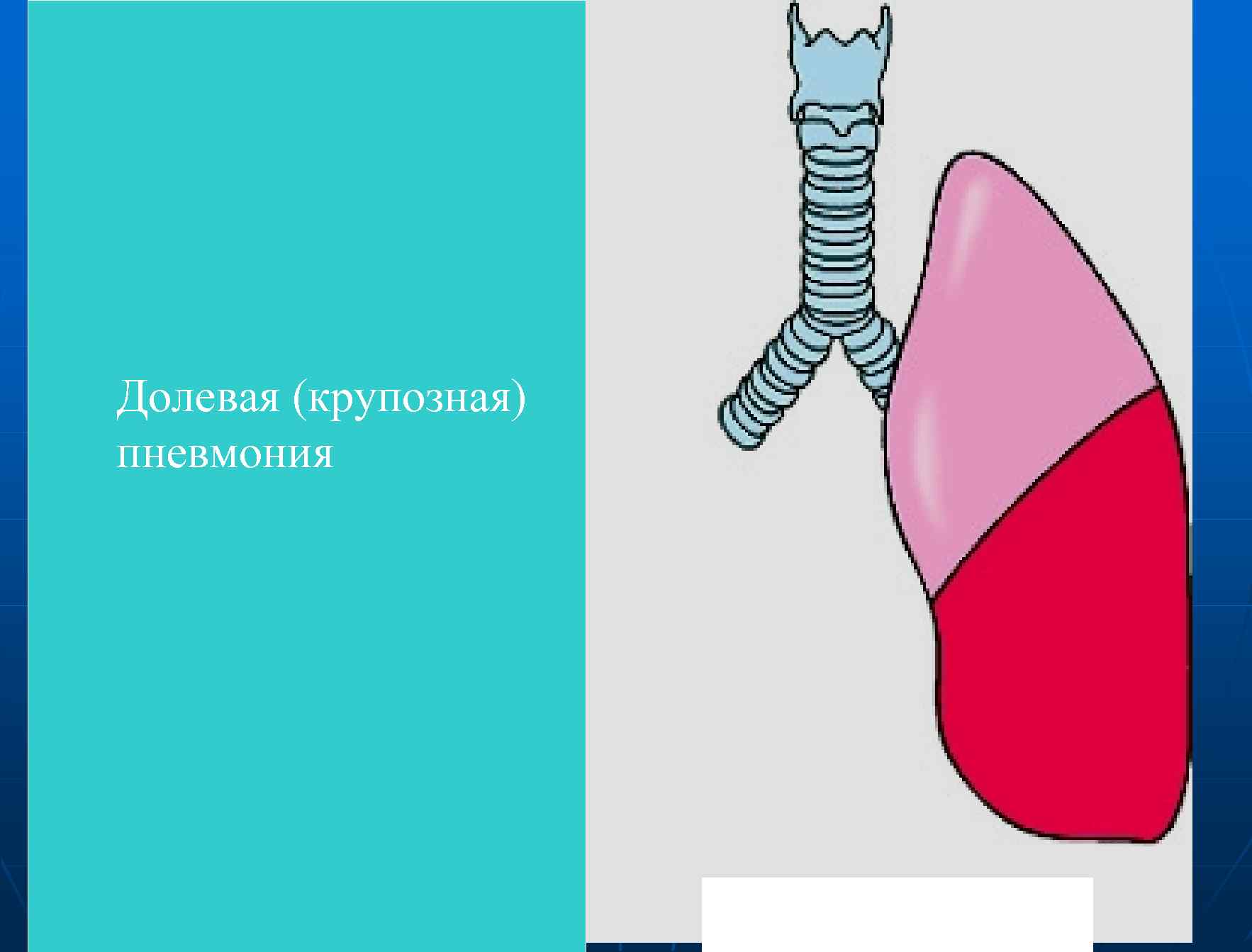 Крупозная пневмония рисунок