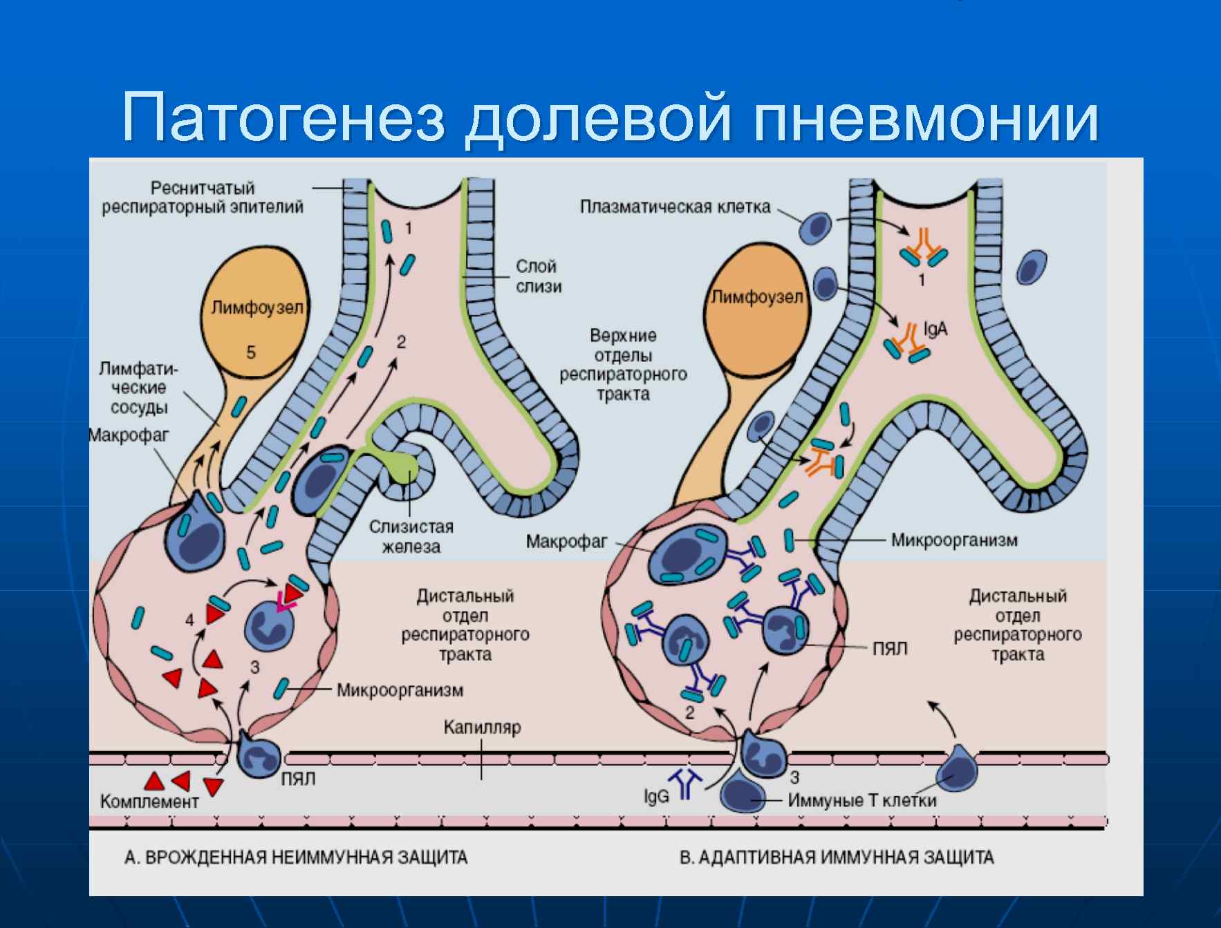 Пути инфицирования при пневмонии схема