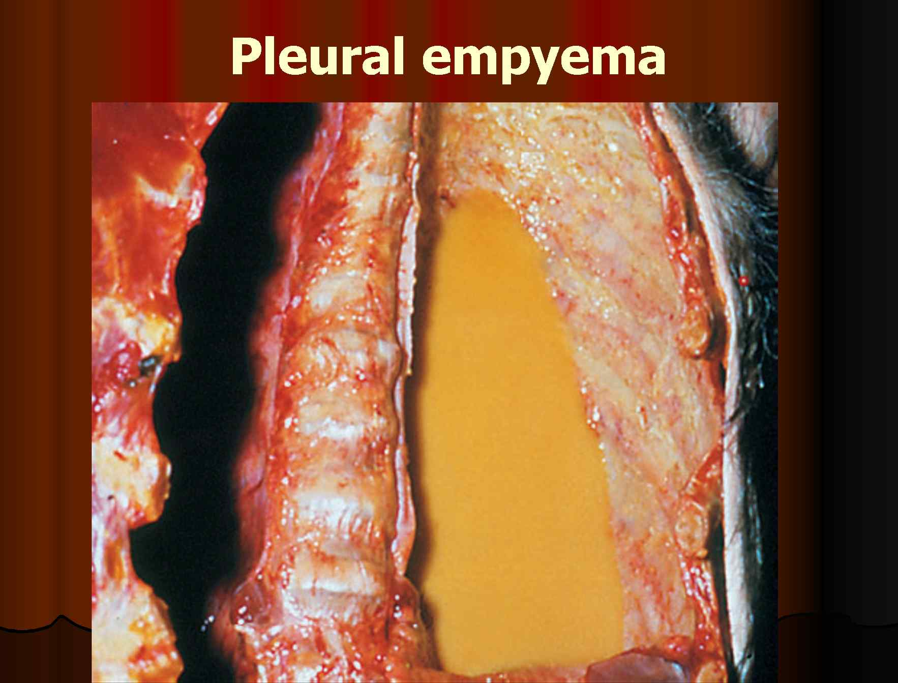 Pleural empyema 