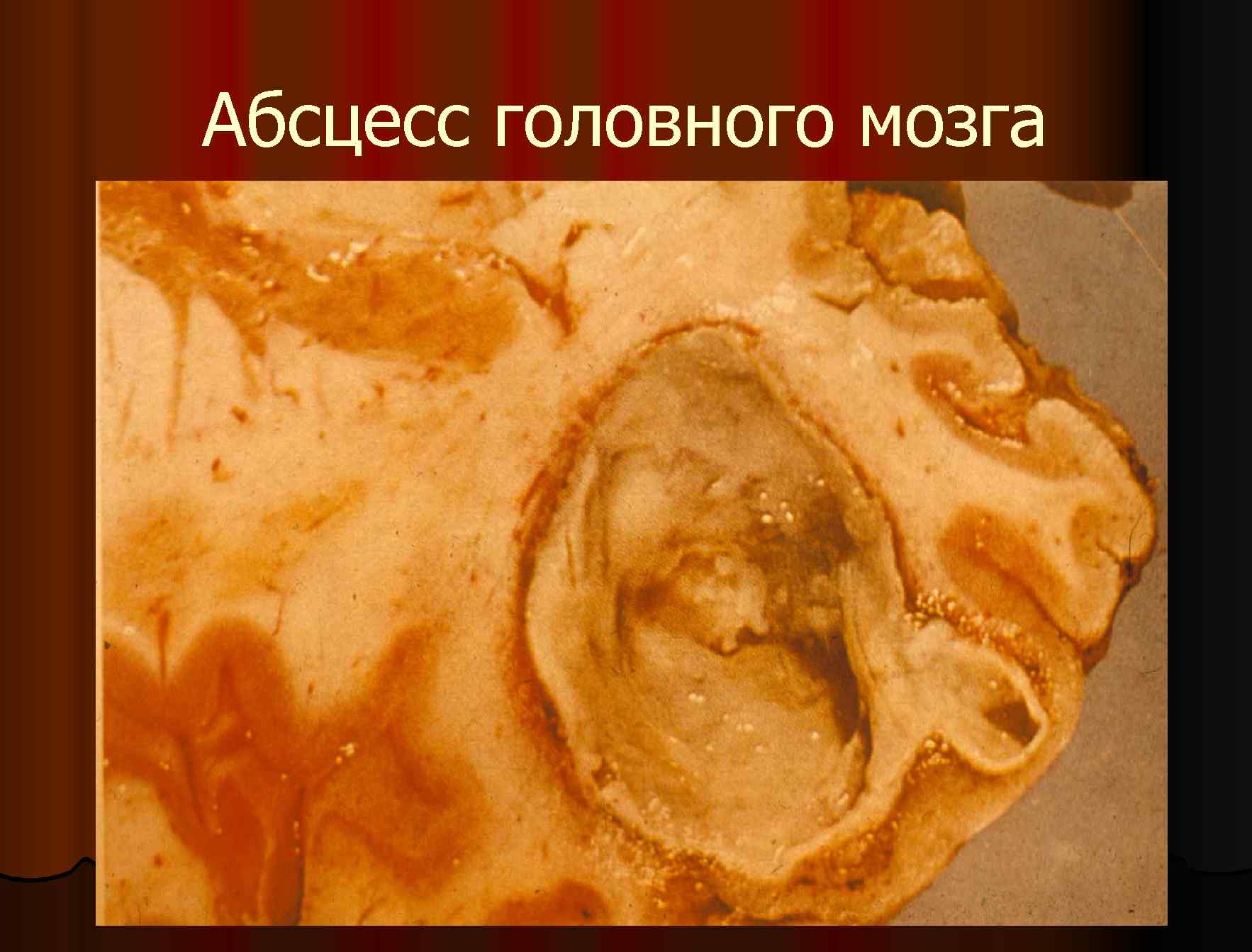 Абсцесс головного мозга 