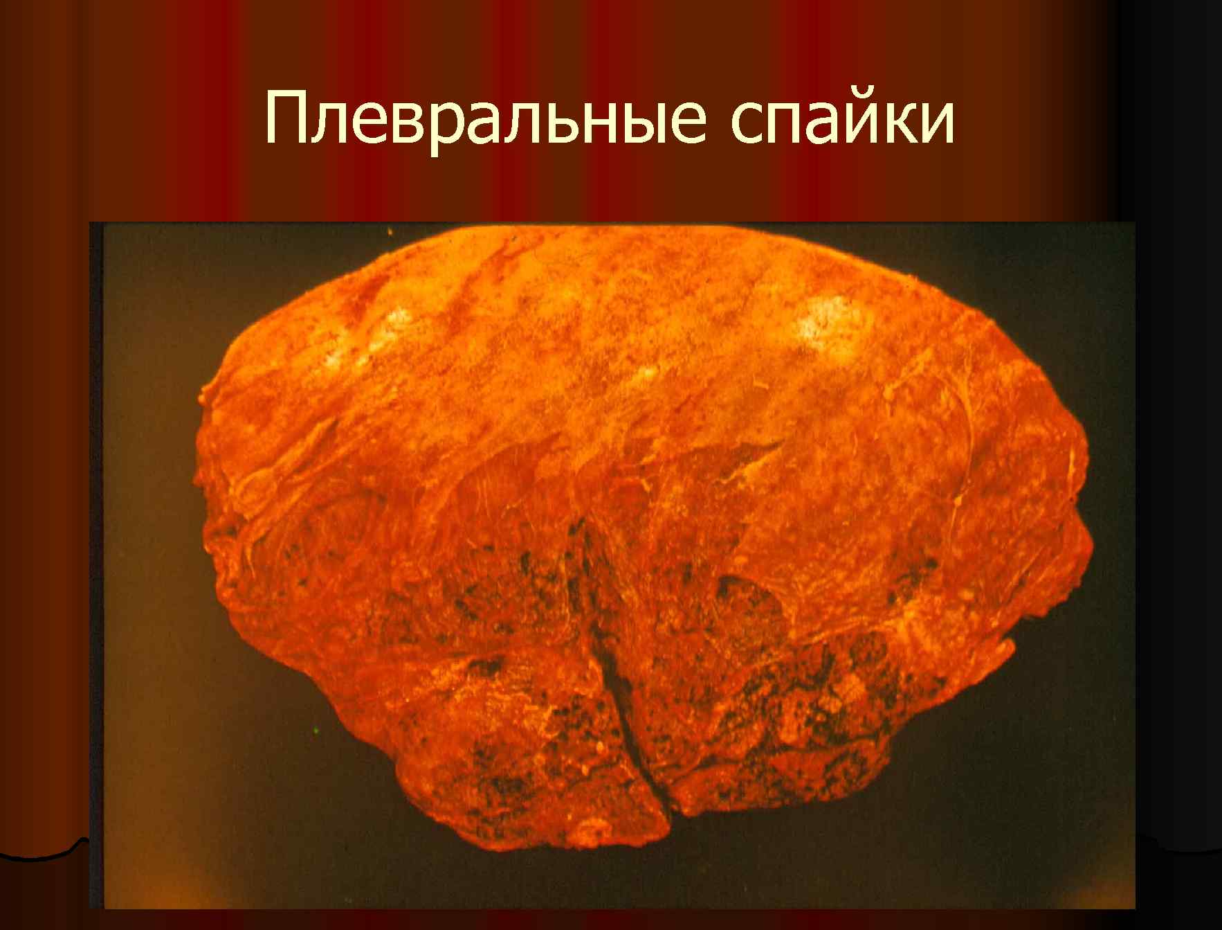 Плевральные спайки 