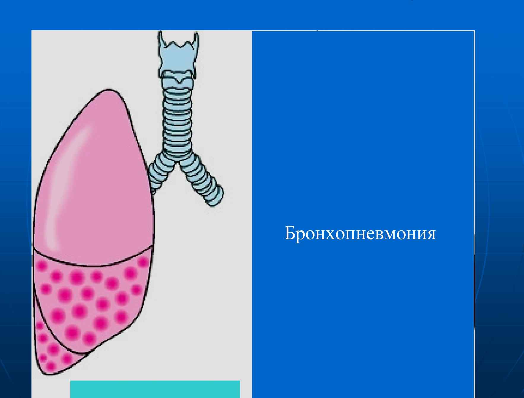 Бронхопневмония 