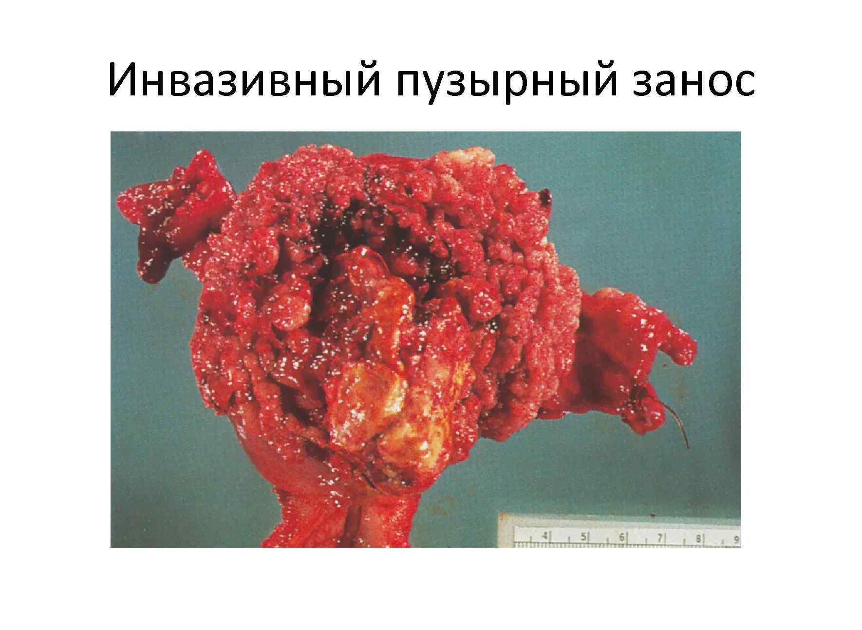 Инвазивный пузырный занос 