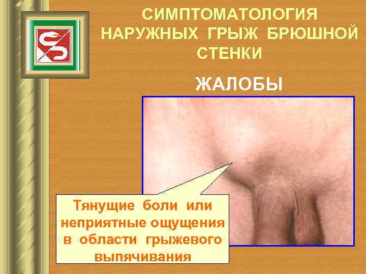   СИМПТОМАТОЛОГИЯ НАРУЖНЫХ ГРЫЖ БРЮШНОЙ   СТЕНКИ    ЖАЛОБЫ Тянущие