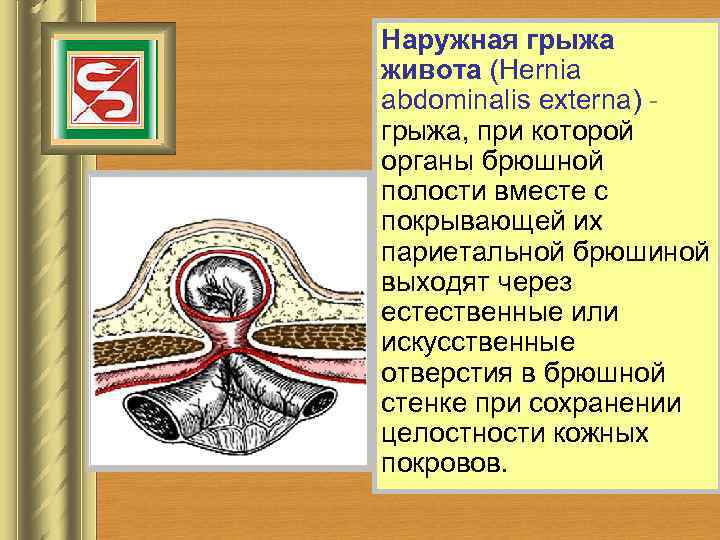 Наружная грыжа живота (Hernia abdominalis externa) - грыжа, при которой органы брюшной полости вместе