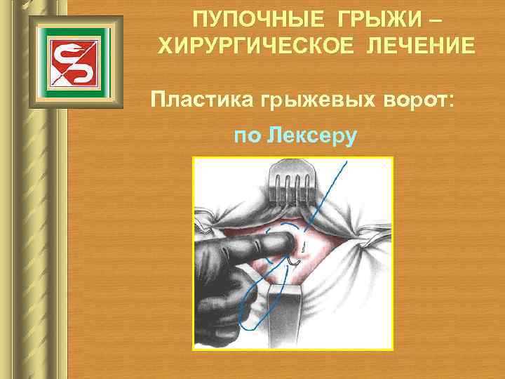  ПУПОЧНЫЕ ГРЫЖИ – ХИРУРГИЧЕСКОЕ ЛЕЧЕНИЕ Пластика грыжевых ворот:  по Лексеру 