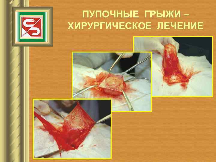  ПУПОЧНЫЕ ГРЫЖИ – ХИРУРГИЧЕСКОЕ ЛЕЧЕНИЕ 