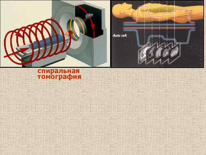 спиральная томография 