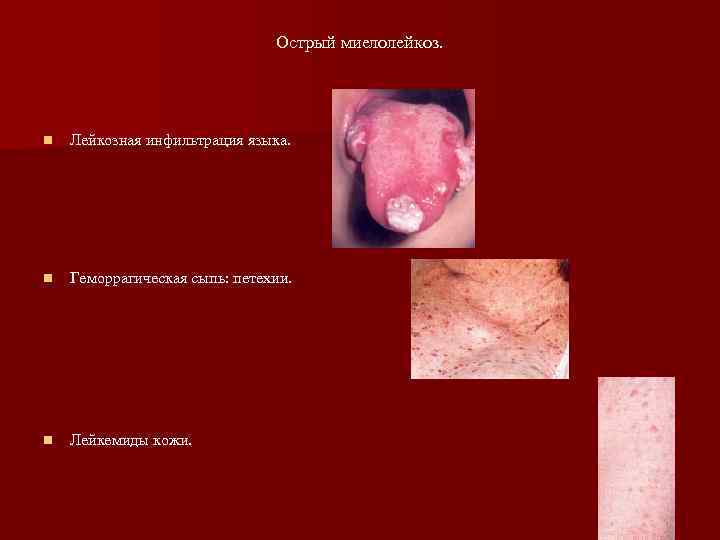       Острый миелолейкоз. n  Лейкозная инфильтрация языка. n