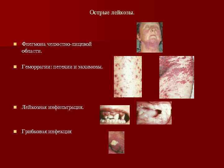      Острые лейкозы. n  Флегмона челюстно-лицевой области.  n