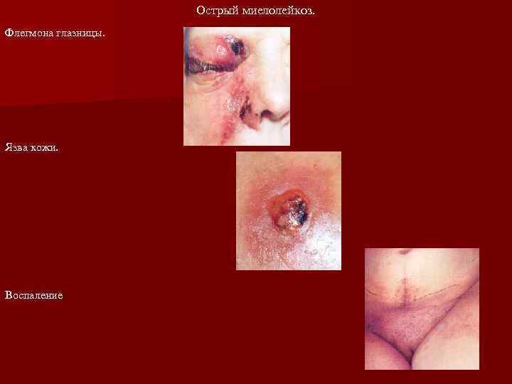      Острый миелолейкоз. Флегмона глазницы. Язва кожи. Воспаление 