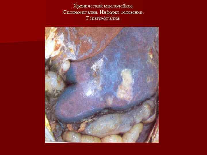   Хронический миелолейкоз. Спленомегалия. Инфаркт селезенки.  Гепатомегалия. 