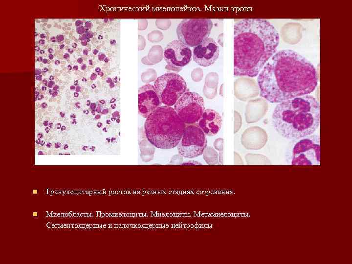    Хронический миелолейкоз. Мазки крови n  Гранулоцитарный росток на разных стадиях