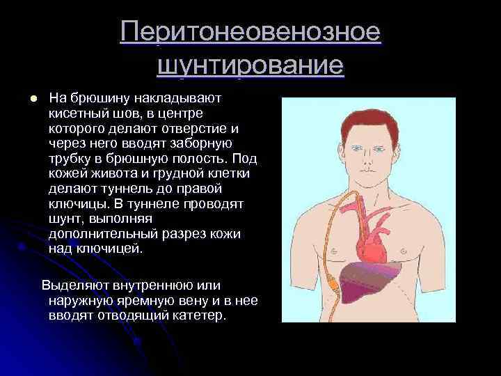 Перитонеовенозное шунтирование l На брюшину накладывают кисетный шов, Перитонеовенозное шунтирование l На брюшину накладывают кисетный шов,