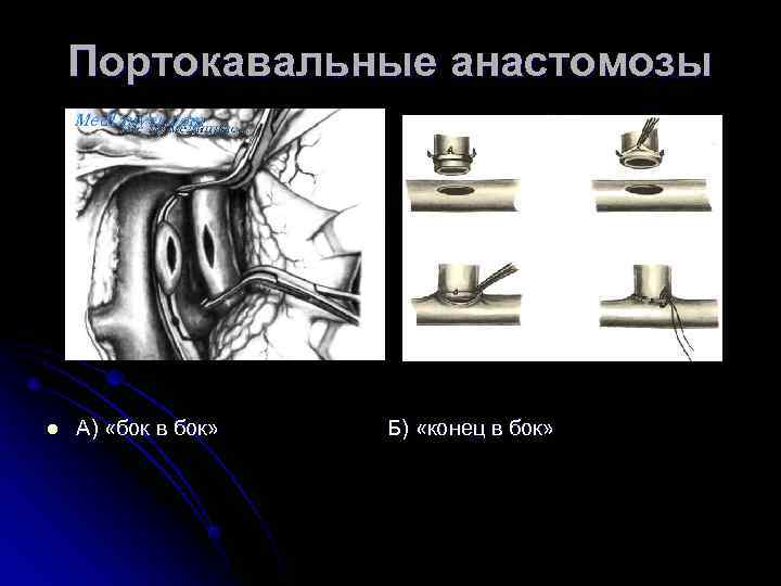 Кавакавальные анастомозы и портокавальные схема