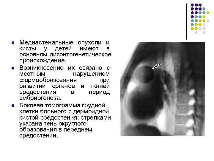 Опухоли средостения презентация