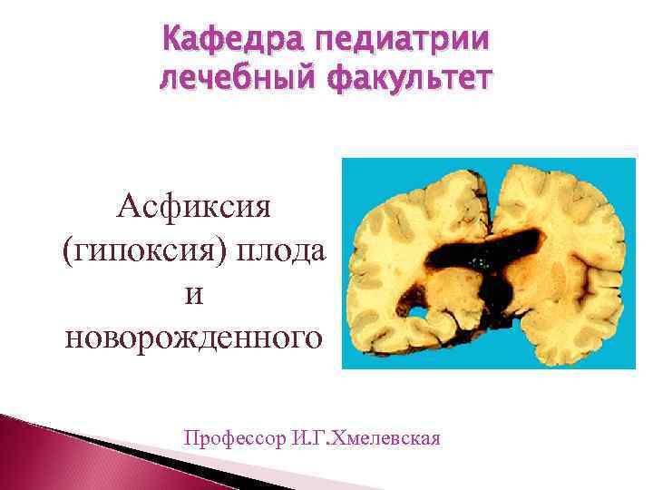  Кафедра педиатрии лечебный факультет Асфиксия (гипоксия) плода  и новорожденного   Профессор