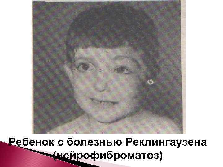 Ребенок с болезнью Реклингаузена  (нейрофиброматоз) 