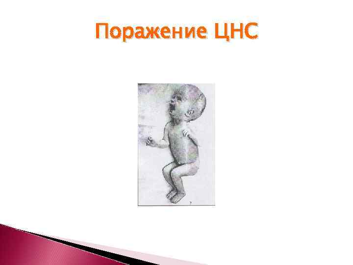 Поражение ЦНС 