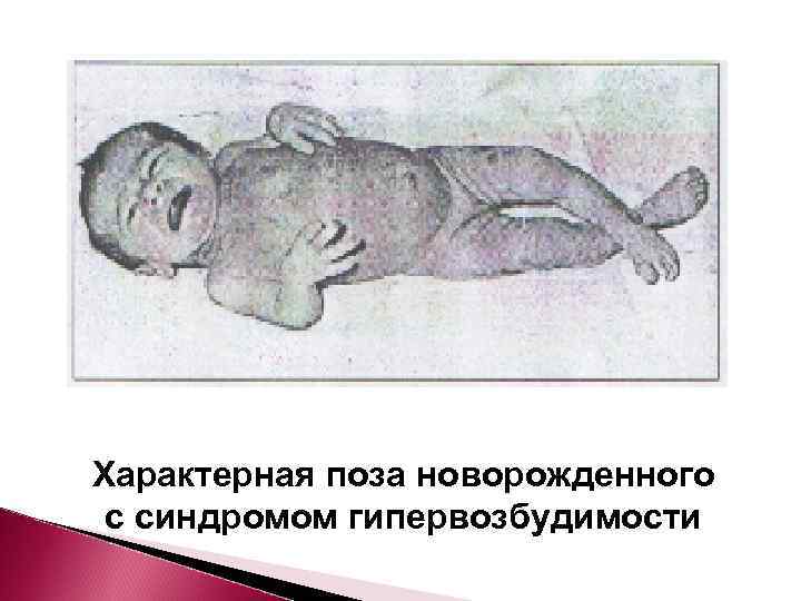 Характерная поза новорожденного с синдромом гипервозбудимости 