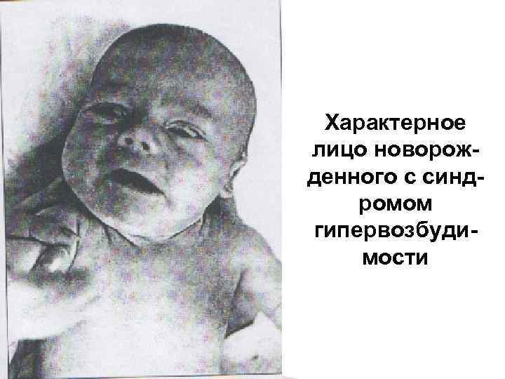  Характерное лицо новорож- денного с синд- ромом гипервозбуди- мости 