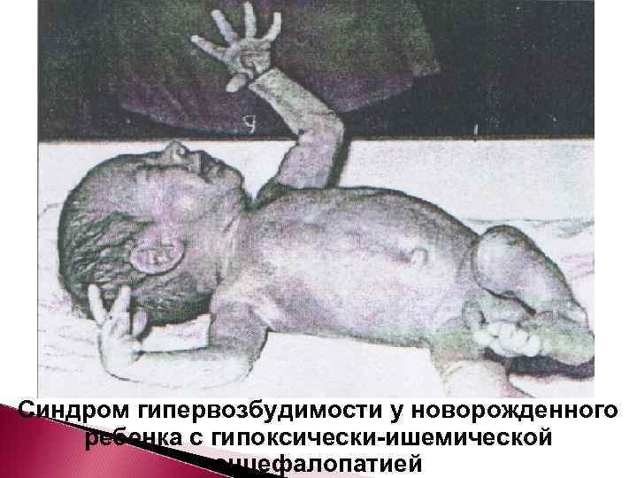Синдром гипервозбудимости у новорожденного ребенка с гипоксически-ишемической    энцефалопатией 