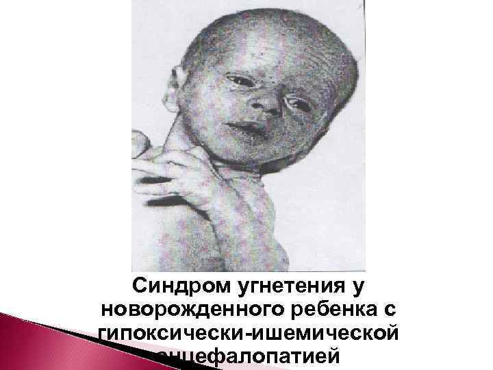   Синдром угнетения у новорожденного ребенка с гипоксически-ишемической энцефалопатией 