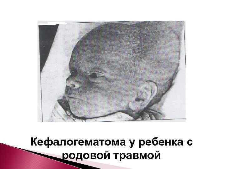 Кефалогематома у ребенка с родовой травмой 