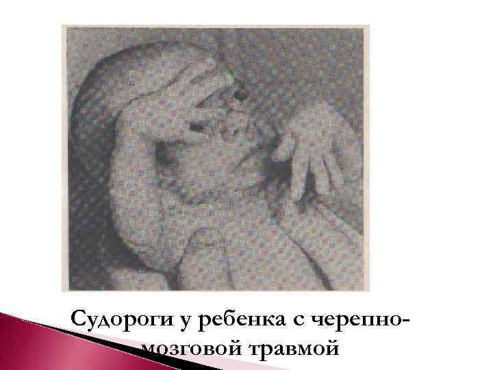 Судороги у ребенка с черепно- мозговой травмой 