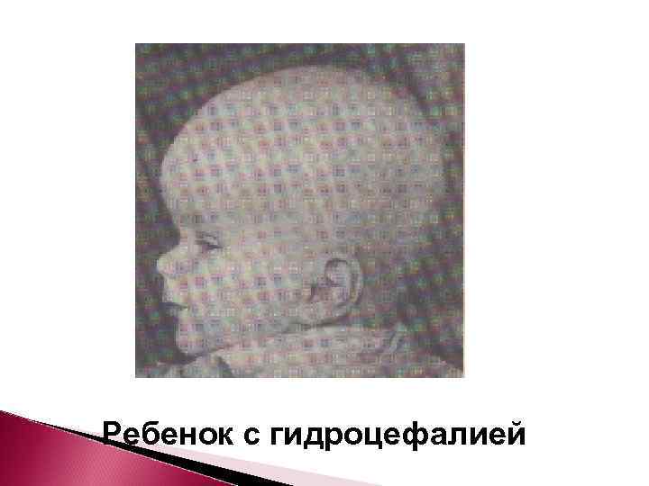 Ребенок с гидроцефалией 