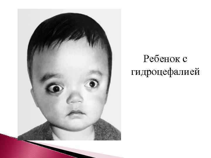  Ребенок с гидроцефалией 