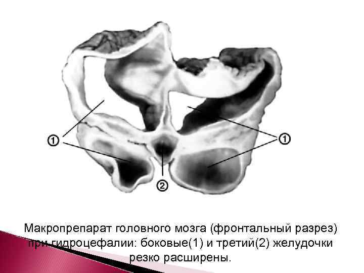 Макропрепарат головного мозга (фронтальный разрез) при гидроцефалии: боковые(1) и третий(2) желудочки   резко