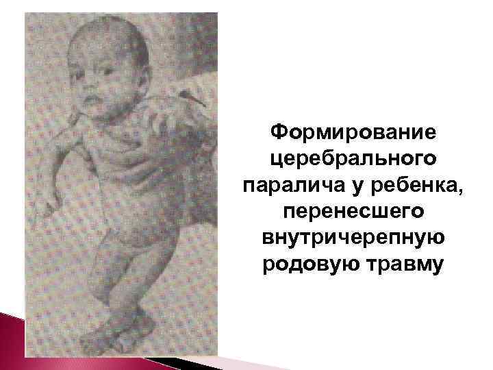  Формирование  церебрального паралича у ребенка, перенесшего внутричерепную  родовую травму 