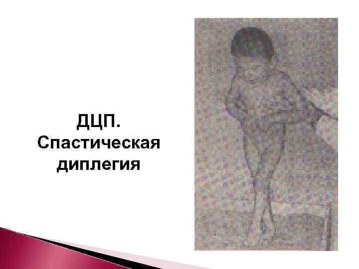   ДЦП. Спастическая  диплегия 