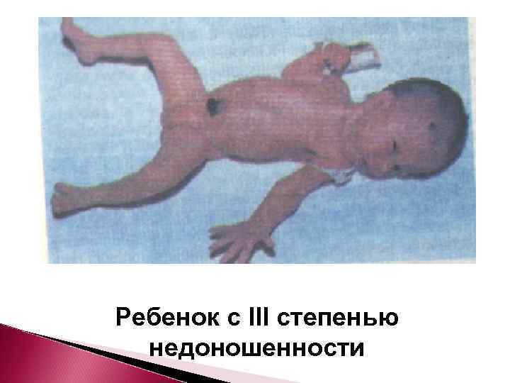 Ребенок с III степенью  недоношенности 