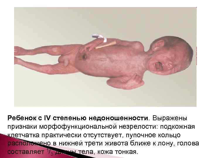 Ребенок с IV степенью недоношенности. Выражены признаки морфофункциональной незрелости: подкожная клетчатка практически отсутствует, пупочное