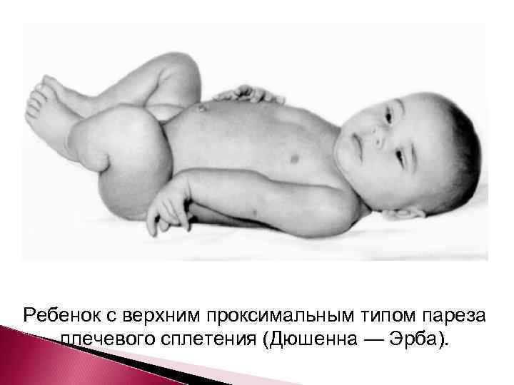 Ребенок с верхним проксимальным типом пареза  плечевого сплетения (Дюшенна — Эрба). 