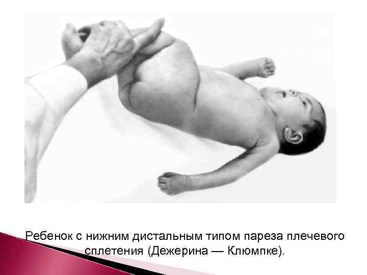 Ребенок с нижним дистальным типом пареза плечевого  сплетения (Дежерина — Клюмпке). 